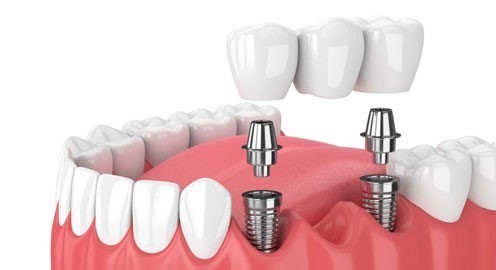 CHĂM SÓC RĂNG SAU KHI CẤY IMPLANT